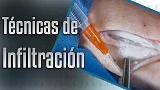 Técnicas de infiltración