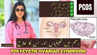PCOS (Polycystic Ovarian Syndrome) complete guide with easy solutions. #pcos #healthcaretips