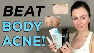 How to get rid of BODY ACNE: best products + top tips | Dr Sam Bunting