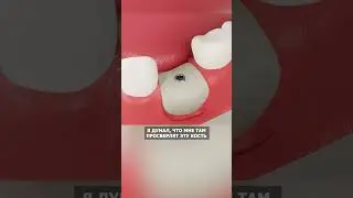 Насколько болезненна имплантация? 