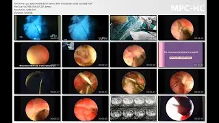 Endoscopic Trans-Pelvic Blunt Dissection Of The Proximal Ureter for Recanalization Of the UPJ