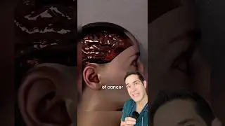 Doctor Reacts: cell phones cause cancer?!