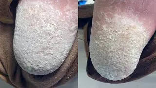 Super thick foot skin, like a layer of snow【Pedicure Master Lin Jun】