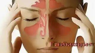 Sinusitis: How I Got Rid of Sinusitis Permanently 32 Years Ago