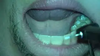 Composite Injection Technique