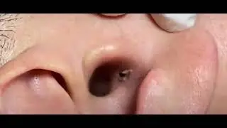 CRAVO GIGANTE na orelha 👂 - Vídeos Satisfatórios