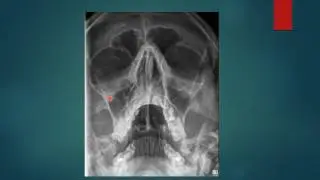 PARANASAL SINUSES RADIGRAPHY PNS X RAYS  WATERS VIEW