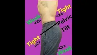 Anterior Pelvic Tilt Correction Exercises (Fix Bad Posture In 30 Days)