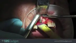 Extraction, Implant Removal and Grafting with Horizontal PRF Centrifuge
