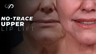 BEFORE and AFTER Lip Lift Results You Won't Believe!