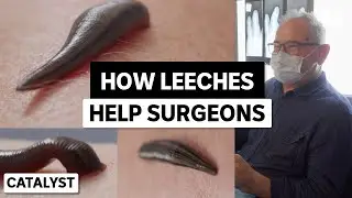 Blood-sucking leeches changed Cole’s life