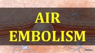 Air embolism during myoma resection by Osama Shawki