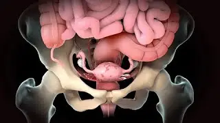 Endometriosis