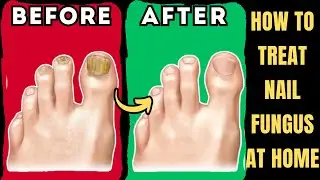 How To Treat Nail Fungus At Home | Best Nail Fungus Treatment