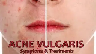 Efficacy of Adapalene 0.1% and Benzoyl Peroxide 2.5% Gel for the Treatment of Acne Vulgaris