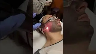 PicoSure Charcoal Laser Facial