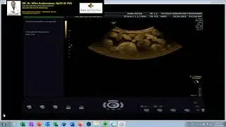 NEOPLASMA OVARIUM CURIGA GANAS - DISGERMINOMA (Dr Wiku Andonotopo)