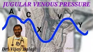 JUGULAR VENOUS PRESSURE