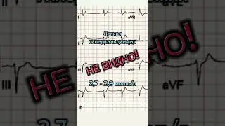 #гиперкальциемия  #ecg #экг #ekg