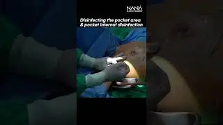 [LIVE SURGERY] Breast Augmentation with Motiva Implant | WHERE is the Incision for Breast Surgery?