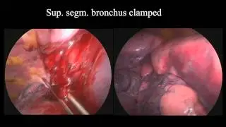 Single-Incision VATS (SIVATS) Segmentectomy for Lung Cancer