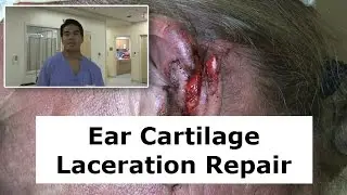 Ear Cartilage Laceration Repair