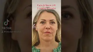 Face & Neck Lift 3 months Natural results! #shorts #facelift #plasticsurgery