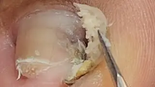 Malaking kuko nakabaon