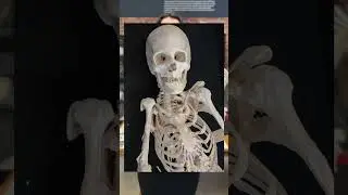 Fibrodysplasia ossificans progressiva (FOP)