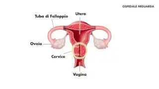 Conizzazione cervicale