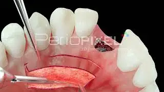 Vídeo 3D Sellado alveolar preservación de volumen con injerto palatino pediculado - Tráiler