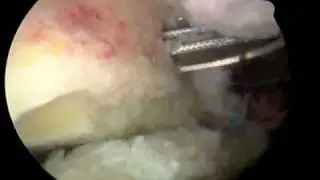 Hip Arthroscopy Placement Suture Anchor