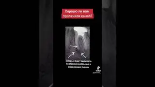 Хорошо ли вам пролечили канал?