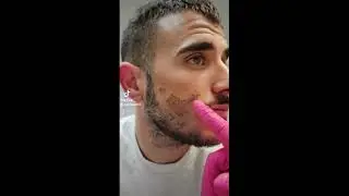 הסרת חטטים וצלקות פוסט אקנה ללא כאבים😍