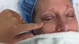 Upper and Lower Eyelid Lift - Before and After -  Dr. Anthony Youn