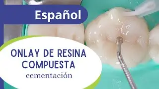 Onlay de resina compuesta - parte 5 final: cementación.