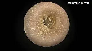 kid's mammoth earwax (removal failed)