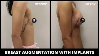 Breast Implants Before and After | Breast Augmentation with Implants