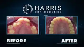 Custom Content Example: Orthodontic Before & After