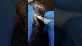 Удаление атеромы кожи головы