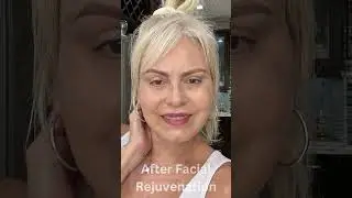 Woman LOOKS 15 YEARS YOUNGER After Facelift Transformation!