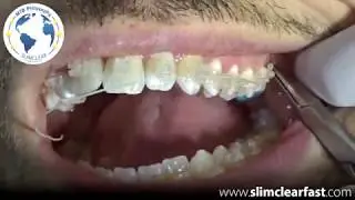 Aesthetic wire Reinsertion