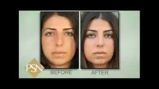 Rhinoplasty on Beverly Hills Female  | Trusted with Noses Worldwide™ | Dr. Paul Nassif
