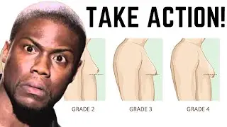 How to Get Rid of Gynecomastia