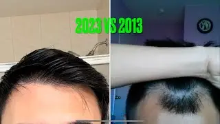 10 YEARS SINCE MY SMP PROCEDURE - MOTION CLINIC, GANGNAM, KOREA HAIR TRANSPLANT