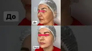 Мезонити на средней трети лица.