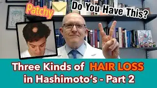 Three Kinds of Hashimoto's Hair Loss - part 2 - patchy alopecia areata (what It means & what to do)