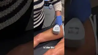 Exilis Ultra for smoothing out the skin and melting fat! #cosmeticderm #bodycontouring