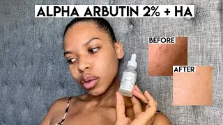 The Ordinary's Alpha Arbutin 2% + HA Review | Fade Dark Spots Fast!!