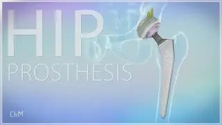 Hip prosthesis - total hip replacement system